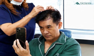 Transplantasi Rambut