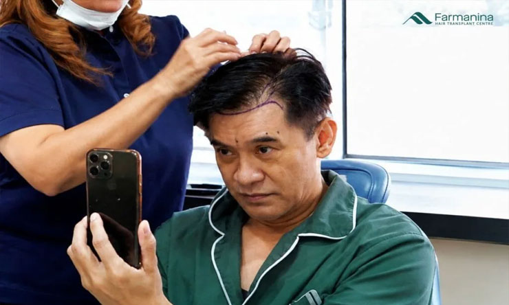 Transplantasi Rambut